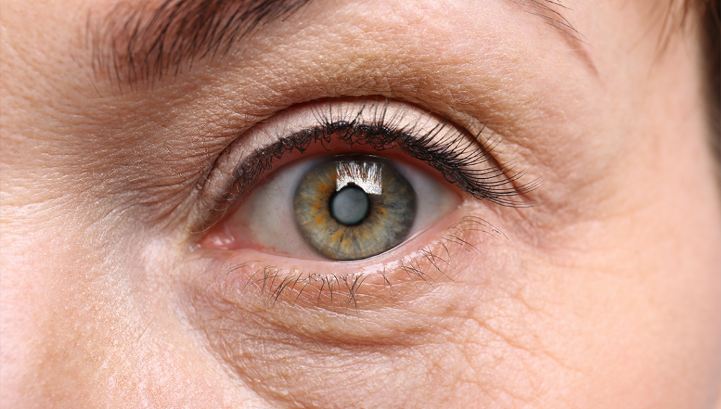 Reverse Cataracts and Improve Eye Health