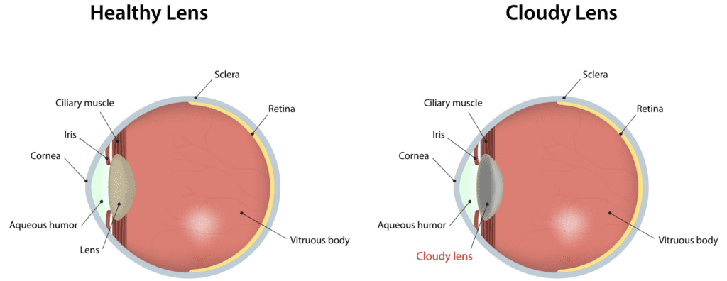 how quickly do cataracts develop